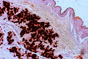 탄력섬유성위황색종의 조직병리학: 알리자린 레드 염색에서 진피 중간층의 탄성 섬유의 분열 및 석회화.