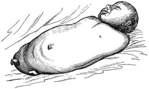 테트라-아멜리아 증후군을 앓고 있는 영아