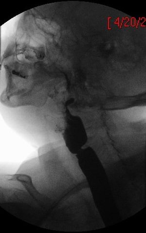 우측 후사위 복위 단일 조영 투시 영상으로 원형의 얇은 경부 식도 웹을 보여준다.