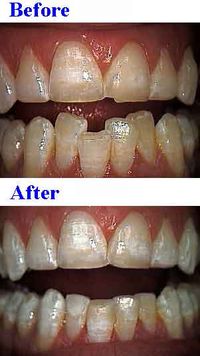 한 번의 진료로 시행된 치아 성형 (조각) 및 레진 충전