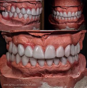 인상으로 제작된 모형에 크라운 왁스 모형