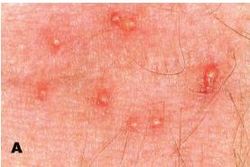 가려움증 진드기(Pyemotes herfsi)에 물린 자국