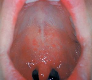 인두 주변의 코플릭반