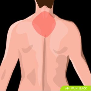 심근경색의 일반적인 부위를 색으로 표시한 등 부위