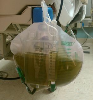 진정제 프로포폴의 장기간 주입 중 녹색 소변.