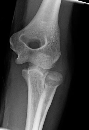 오른쪽 팔꿈치 탈구 전후 X-레이