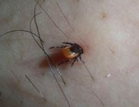 사람을 흡혈 중인 진드기