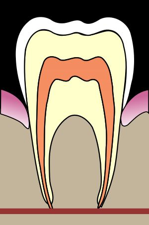 C0 치아의 불투명감이나 백반, 색소 침착이 보이지만 우치를 확인할 수 없다.