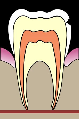 C1 법랑질로 진행된 우식(법랑질 우식). 대책에 따라 C0으로 돌아갈 가능성도 있다.