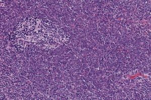 섬유 형성성/결절성 수모세포종, WHO 등급 IV