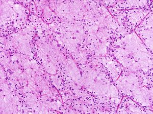 배아 이형성 신경 상피 종양 (WHO grade I)