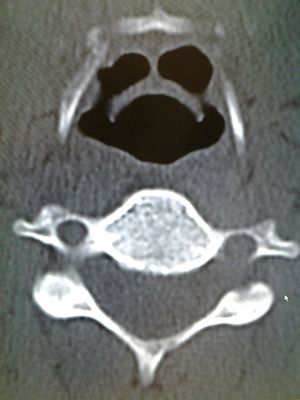 CT 영상에서 "할로윈 징후"를 보여준다.