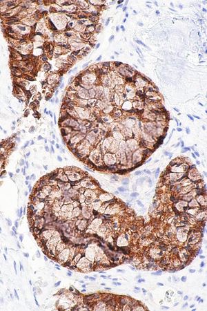 현미경 사진으로 보이는 ALK 양성 폐 선암. ALK 면역 염색.