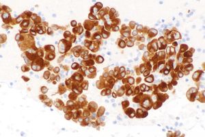 현미경 사진으로 보이는 ROS1 양성 폐 선암. ROS1 면역 염색.
