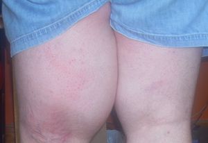 기저 지방육종으로 인한 왼쪽 다리 부종