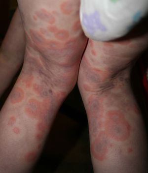 표적 모양 병변