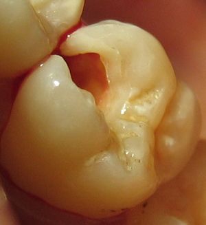 치아 수복 준비 과정의 예시. 윗쪽 어금니의 상아질이 썩어 제거되어, 바깥쪽 치아 에나멜이 지지받지 못하는 모습이다.