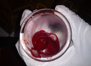 습식 부항으로 뽑아낸 혈액