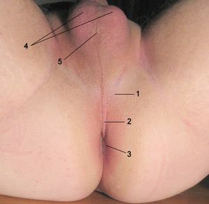 남성 회음부 주석: 1. 회음. 2. 회음봉선. 3. 항문. 4. 고환, 음낭. 5. 음낭봉선.