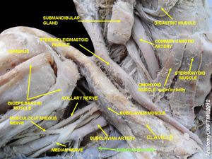 빗장밑정맥 - 우측