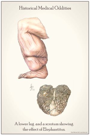 국립 건강 의학 박물관에서 수집한 그림으로, 역사적인 맥락에서 사상충증의 영향을 보여준다.