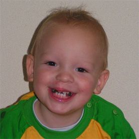 같은 아기, 1년 6개월. 흉터가 점점 줄어들었다.