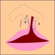 파란색 선은 절개선을 나타낸다.