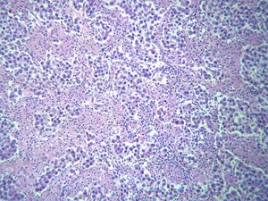 고환의 정상피종. 종양 세포 군집을 분리하고 있는 섬유성의 기질에 림프구의 침윤이 두드러지게 나타난다.