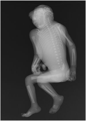 무뇌증 사산아의 엑스레이 사진