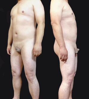 왜소음경증 남성의 전신 이미지