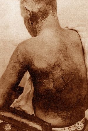 1918년경, 겨자 가스 화상을 입은 군인