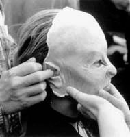 안면 보형물을 적용받는 캐서린 이자벨.