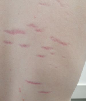 청소년 남성의 일반적인 튼살