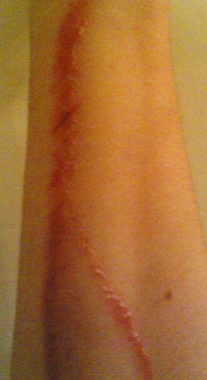 상처 부위가 개방된 모습