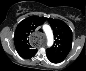 CT 이미지에서 식도이완불능증 환자의 식도가 현저하게 확장된 모습을 볼 수 있다.