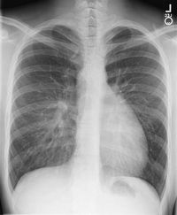 대혈관 전위에서 특징적인 소견을 보여주는 X-레이, 달걀 모양의 심장이라고 불린다.