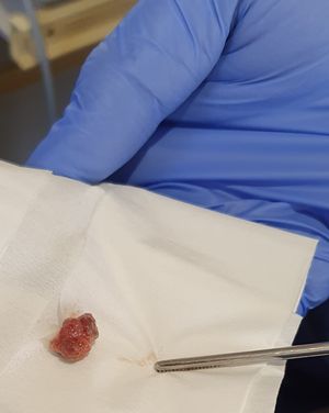 레이저를 사용하여 구개수 뒤에서 제거된 HPV6 유경성 유두종