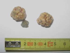 담석(콜레스테롤 담석)