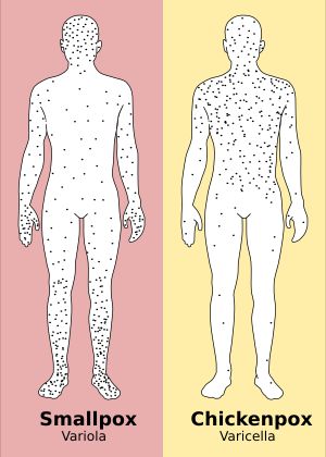 천연두는 몸통보다 사지에 발진이 더 많고, 수두는 반대로 사지보다 몸통에 발진이 더 많다.
